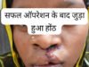 सफलता की कहानी- सफल सर्जरी से भीमे हेमला के चेहरे पर लौटी मुस्कान