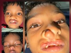चिरायु योजना से जन्मजात समस्या से मिली राहत, तीन बच्चों के चेहरों पर लौटी मुस्कान